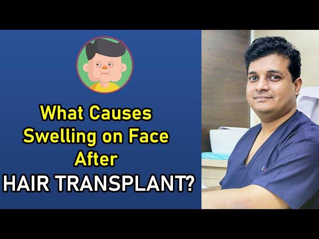 Swollen Face After Hair Transplant | Best Hair Transplant in Delhi | Dermalife