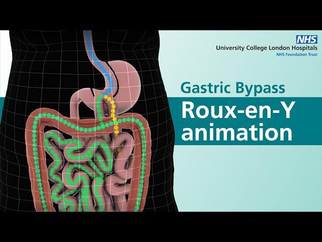 Gastric Bypass | Roux-en-Y animation