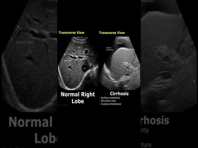 Liver Cirrhosis On Ultrasound | Ascites | Chronic Liver Disease USG  Normal Vs Abnormal #shorts