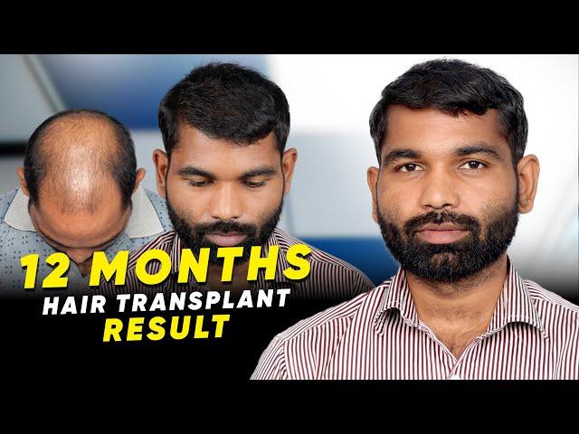 Hair Transplant in India | Best Results & Cost of Hair Transplant in India