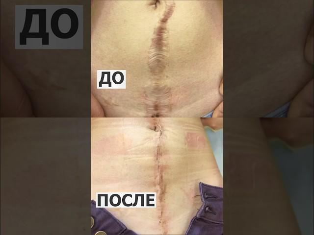 ШРАМДЫ КЕТІРУ -  УДАЛЕНИЯ РУБЦОВ  #almaty #astana #atyrau #kazakhstan #aktau #пластическийхирург