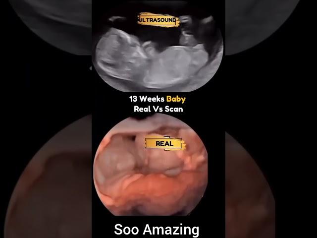 13 week baby real vs scan