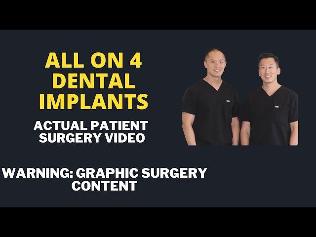 All on 4 Dental Implant Patient Surgery Video. How We Plan and Perform the Surgery