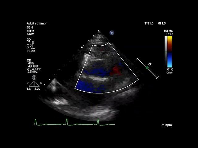 Asvide: Color Doppler flow imaging showed reverse flow in the left coronary artery.