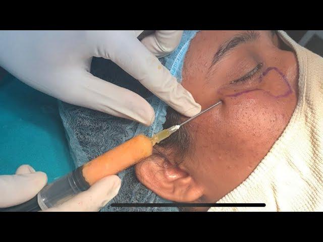 Under eye fat grafting|Indore|mumbai|zenith clinic|Dr Sumeeet Jaiswal