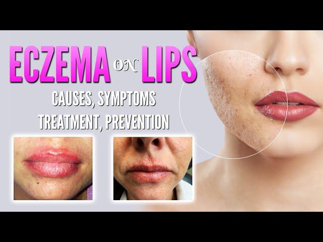 Eczema on lips causes, symptoms, treatment, remedies, prevention | Lip dermatitis, Lip Cheilitis