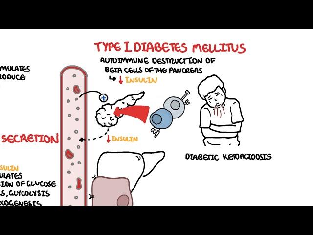 Type I and Type II Diabetes, chronic complications and management