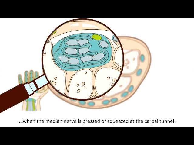 Carpal Tunnel Syndrome (CTS) - What is Carpal Tunnel Syndrome and how is it treated?