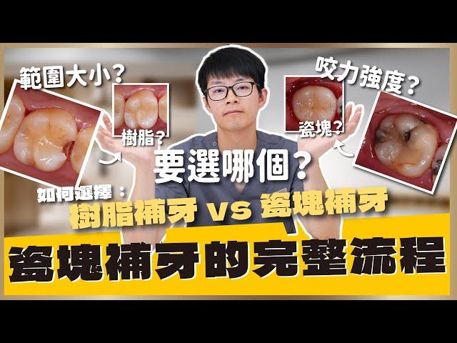 瓷塊補牙的治療流程！發生蛀牙的時候該選擇哪種治療方式？選擇樹脂還是瓷塊到底有什麼差別呢？｜【祐民牙醫－隱適美旗艦店】鑽石級楊大為醫師 #蛀牙 #瓷塊補牙 #樹脂補牙 #祐民牙醫