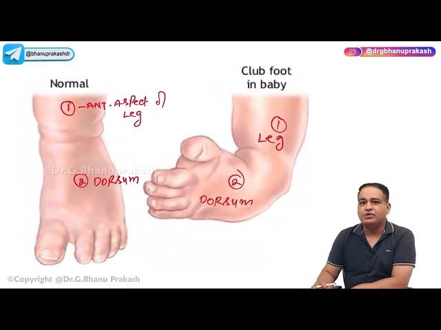 Club Foot / Congenital talipes equinovarus (Hindi) : Orthopedic Lectures