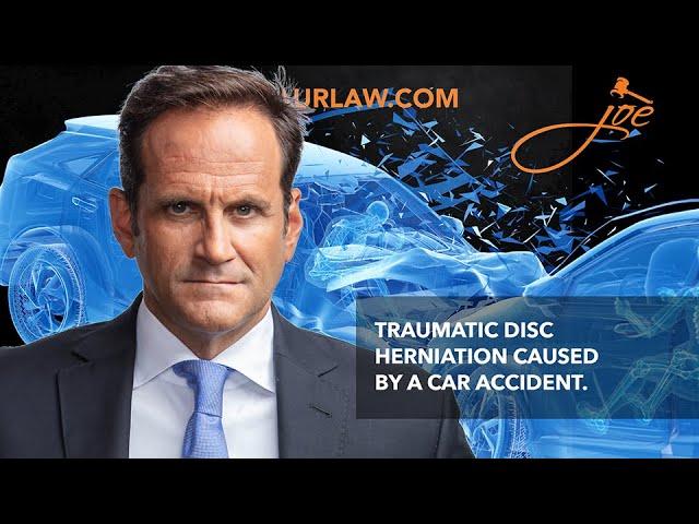 Zarzaur Law, P.A. TV: How Does a Car Accident Cause a Disc Herniation?