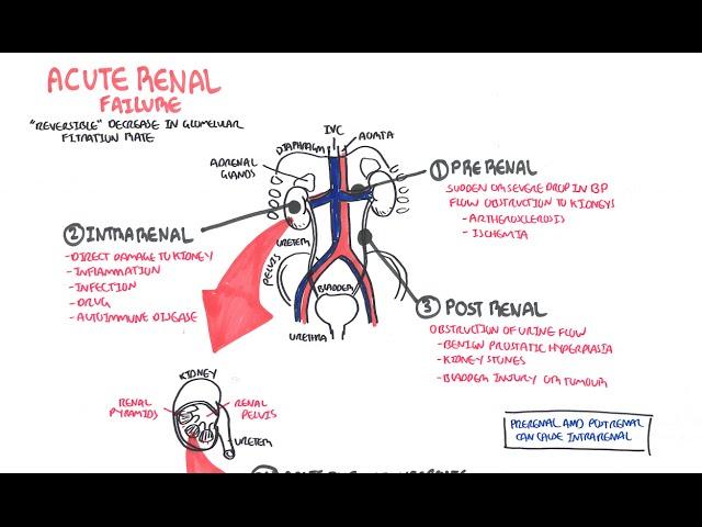 Acute Renal Failure