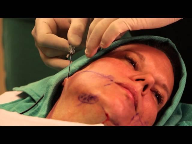 Dr. Bullis-ThermiTight Chin Demo