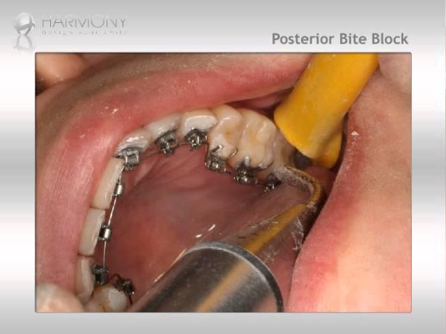 posterior bite block