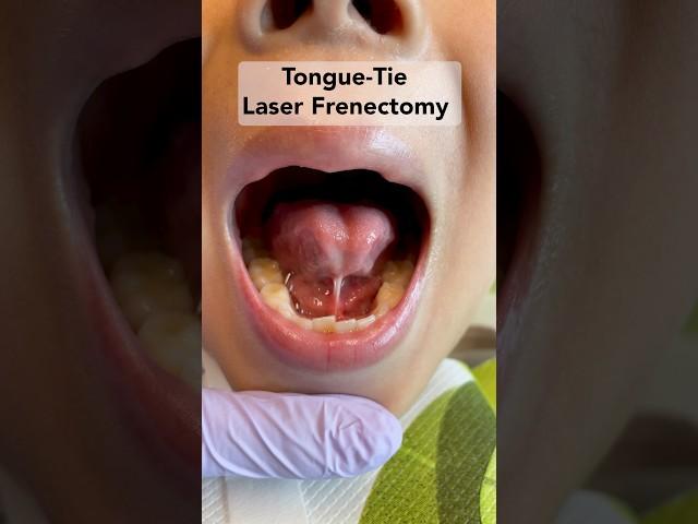 Tongue-Tie Laser Treatment