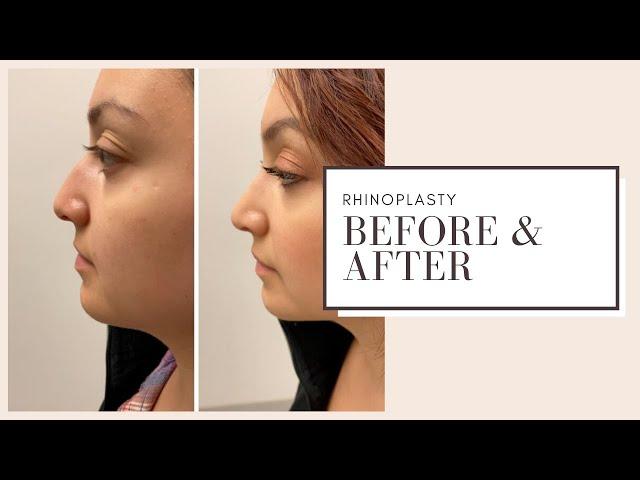 Plastic Surgery Before & After | Rhinoplasty | ESKMD NYC