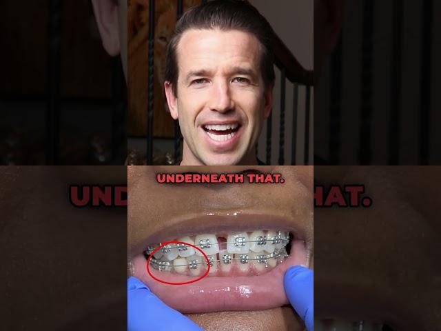Baby tooth problems. #babytooth #missingtooth #braces