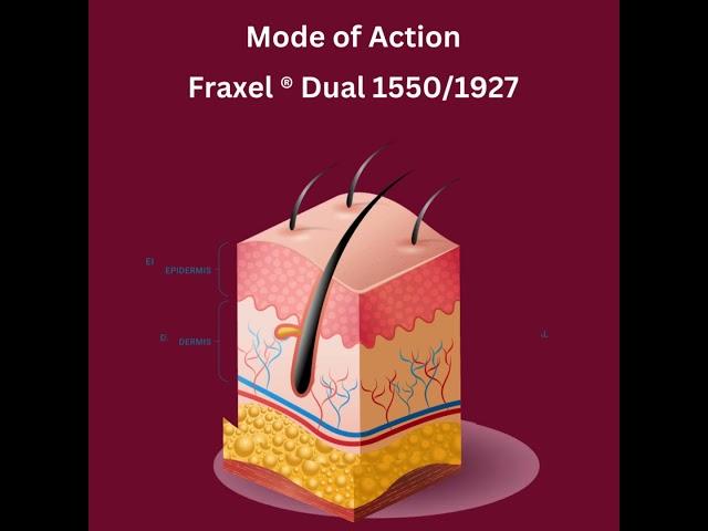 Fraxel Mode of Action