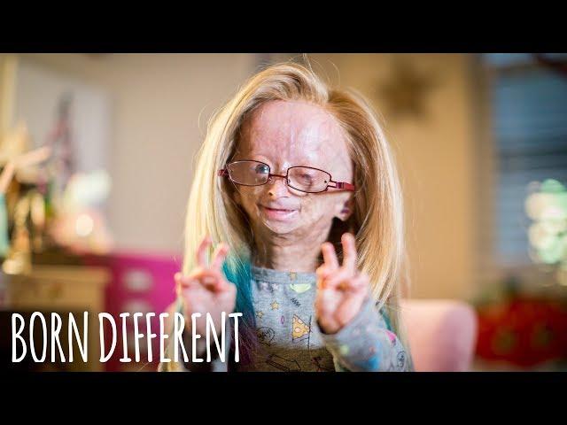 Adalia Rose: The Girl Who Ages Too Fast | BORN DIFFERENT