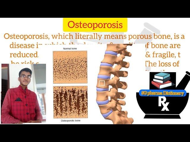 Osteoporosis ll Definition in Hindi ll Symptoms , Course , Treatment ll @SG Pharma Dictionary1M