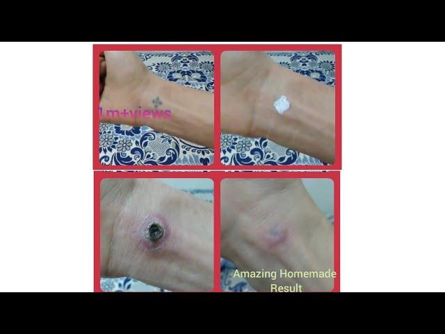 Simple way to remove tatoo at home . Acidic 100% Formula