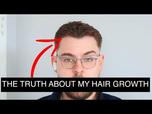 I Got PRP Injections For Hair Loss Heres What Happened | PRP Results Before And After