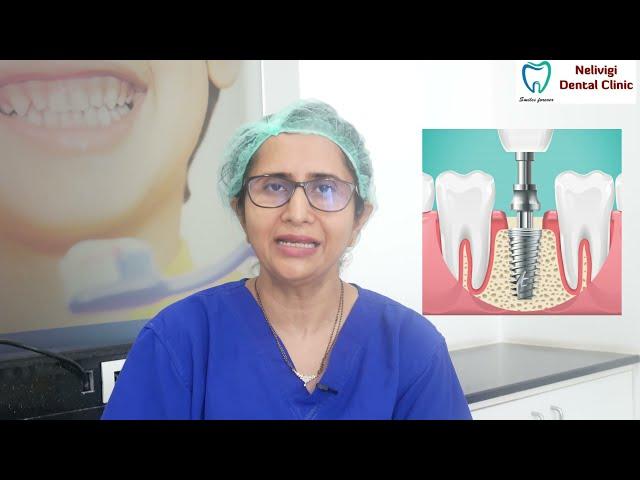 What are dental implants | Best Dental Clinic in Bangalore | Nelivigi Dental Clinic