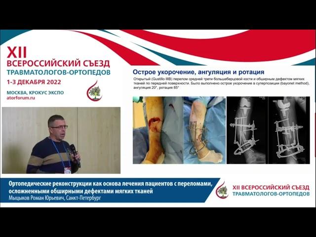 Ортопедические реконструкции как основалечения пациентов с переломами, осложненными обширными деф...