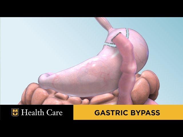 Bariatric Surgery Seminar: Gastric Bypass