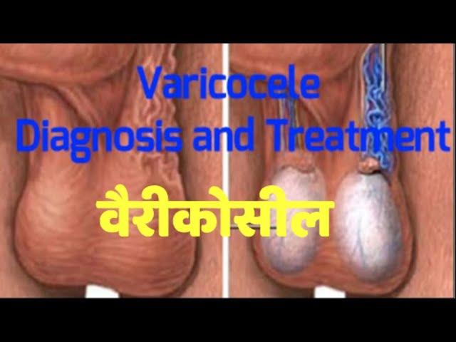 VARICOCELE - Symptoms, Causes and Treatment in  HINDI, Dr Santosh Agrawal