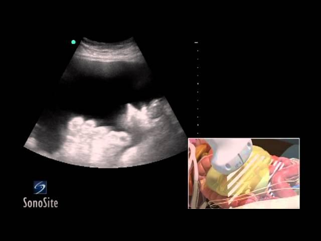 How To: Ultrasound Guided Paracentesis Procedure 3D Video