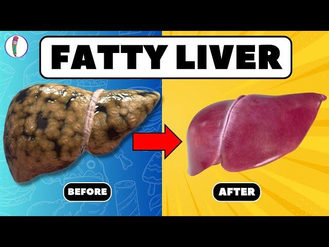Strictly Avoid these 5 Foods if you have Fatty Liver | Fatty liver treatment | liver disease