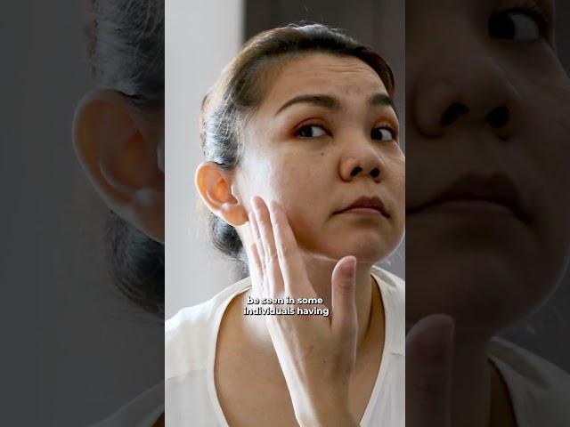 Laser hair removal increased her hair growth  Know why!