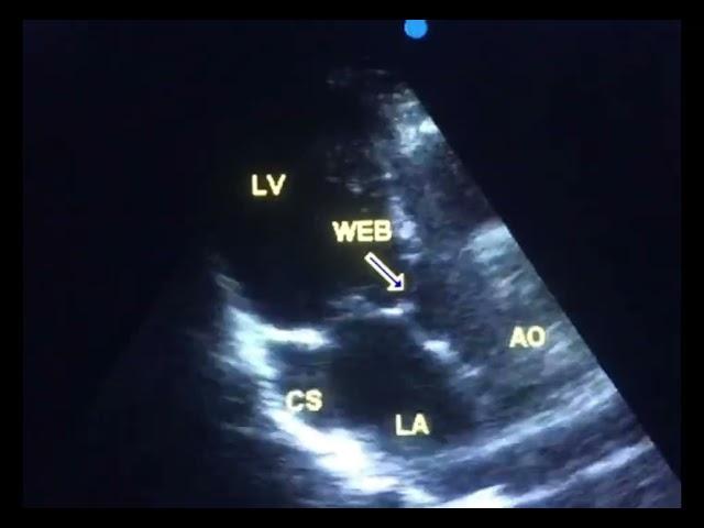 Sub aortic stenosis, is it a congenital heart disease? @ to drahmadmirdamadi?si=Ki_JIzZBvYvqoKkZ