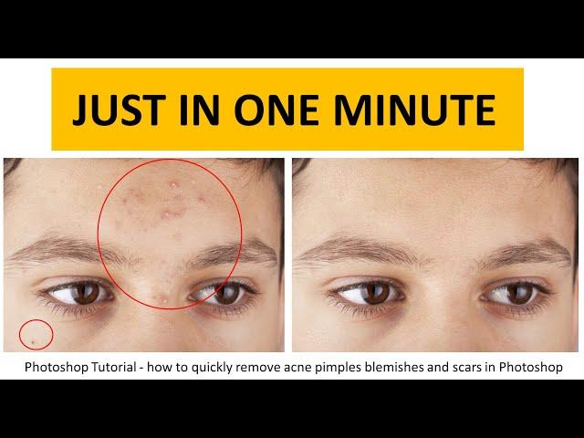 how to remove acne pimples or dark spots in photoshop | remove acne from photo photoshop tutorial