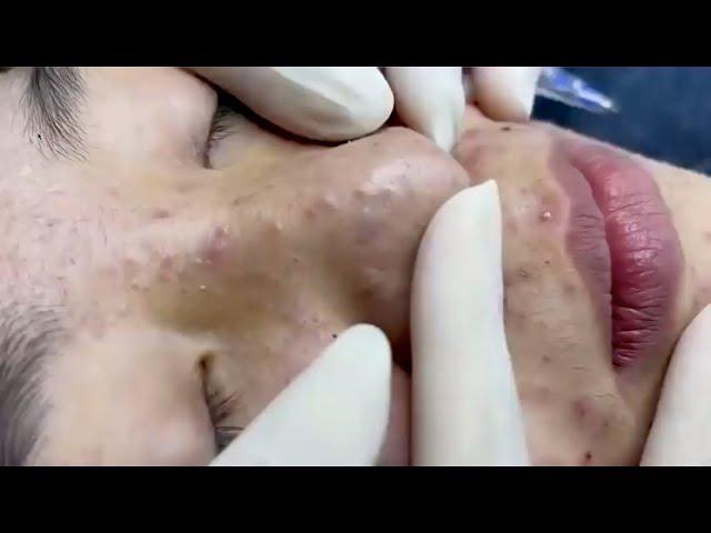 2 RELAXING BLACKHEAD | WHITEHEAD REMOVAL SPA VIDEOS | NOSE | SATISFY EVERYDAY