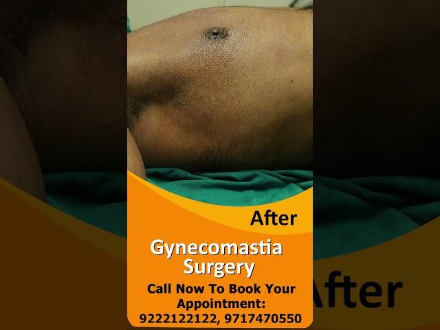 Gynecomastia Surgery result #short