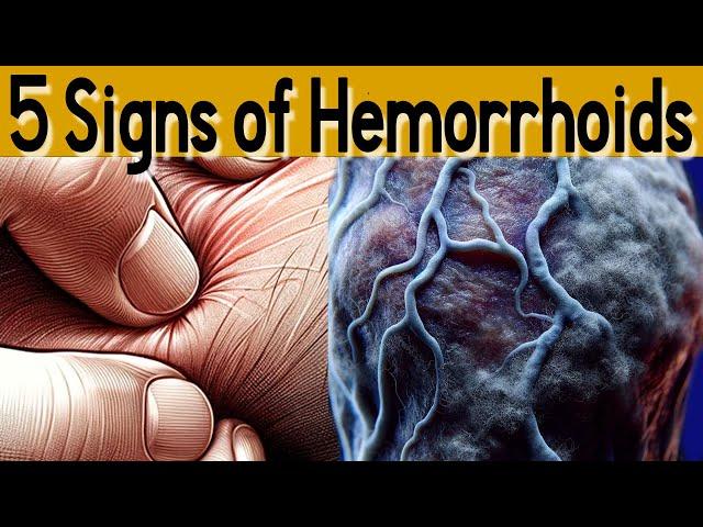 5 signs and symptoms of Hemorrhoids  and treatment