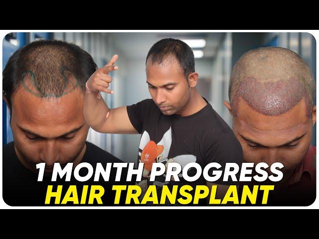 Hair Transplant in Bikaner | Best Results & Cost of Hair Transplant in Bikaner