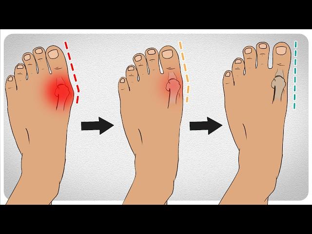 How to Fix Bunions in 5 Steps