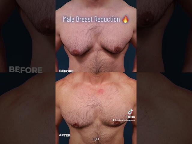 Male Chest Contouring | BEFORE and AFTER