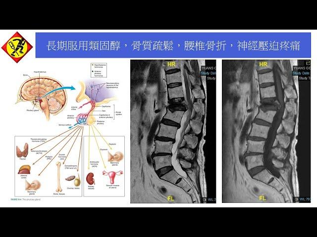 腦下垂體功能低下，腎上腺機能不全， 長期服用類固醇，骨質疏鬆，腰椎骨折，神經壓迫疼痛