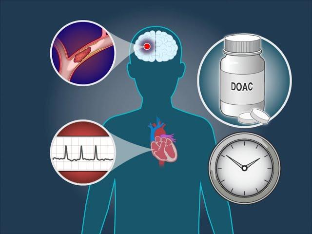 Anticoagulation Timing after Stroke in Atrial Fibrillation | NEJM