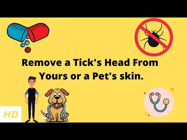 Remove a Tick's Head From Yours or a Pet's skin.