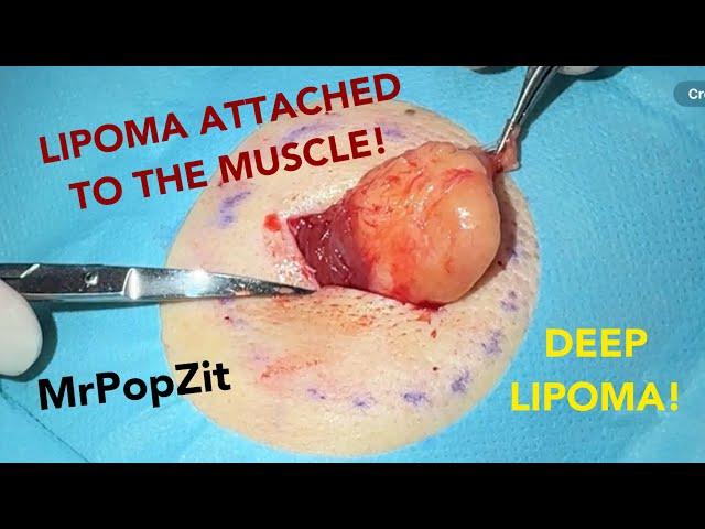 Very deep lipoma attached to muscle on back!Must see lipoma removal.My camera person almost faints!