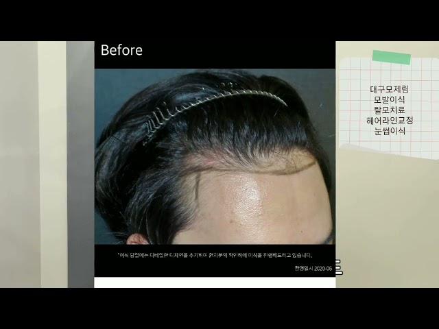 [대구모제림모발이식] 절개수술의 장점,단점 알아보기