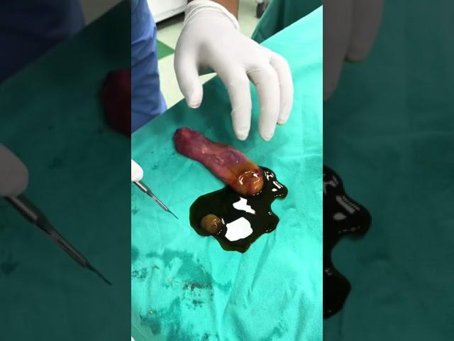 Yeşil Zeytin mi, Safra Taşı mı? #shorts