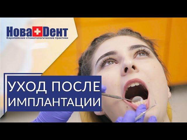  Важные рекомендации после имплантации зубов. Рекомендации после имплантации. НоваДент. 12+