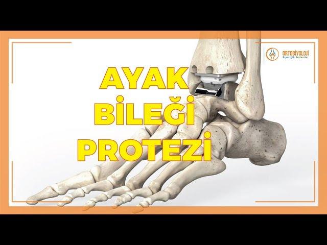 AYAK BİLEĞİ PROTEZİ