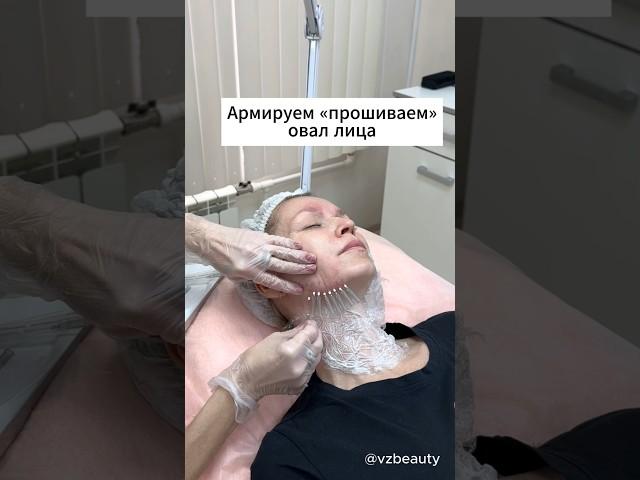 Армирование кожи лица мезонитями. Так же иногда можно встретить термин «прошивание» лица.